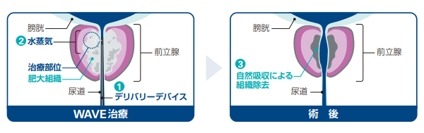 WAVE治療（経尿道的水蒸気治療）とは？01
